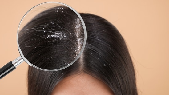 Dandruff increases if you don't take care of your scalp health. (Shutterstock) Dandruff increases if you don't take care of your scalp health. (Shutterstock)